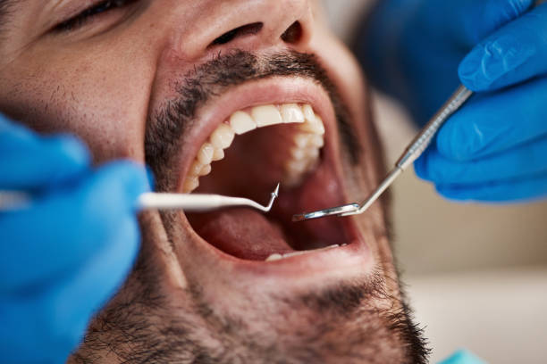 Best Knocked-Out Tooth (Avulsed Tooth) Treatment in Westfield, IN